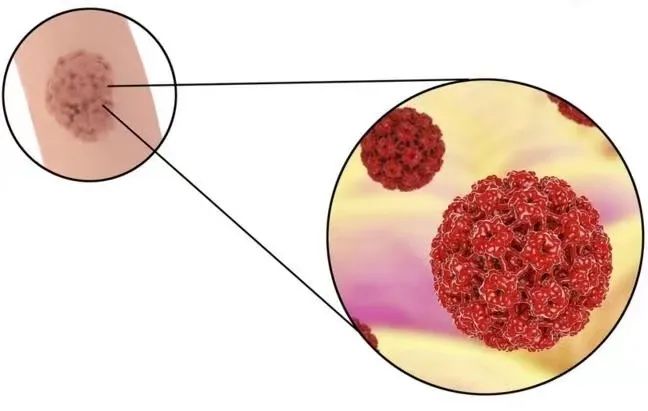 身上5种小疙瘩可能跟HPV感染有关