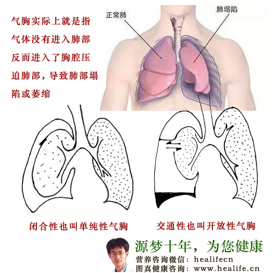 当胸痛来袭，竟然是气胸？你不可不知的隐秘真相！